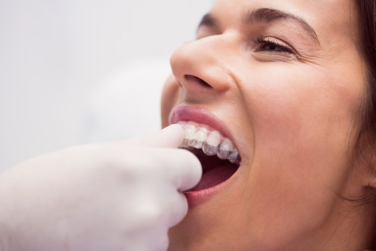 Ortodoncia invisible y tradicional en Clínica Dental Borrego Cirbián, Puente Genil