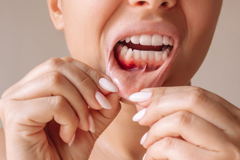 Periodoncia en Clínica Dental Borrego Cirbián, Puente Genil